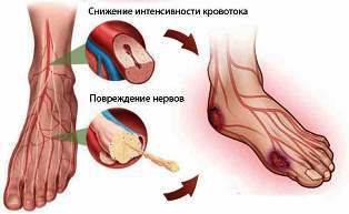 диабетическая нейропатия